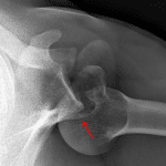 Red arrow: posterior shoulder dislocation with minimally displaced fracture of the posterior glenoid, best shown on this axillary view.