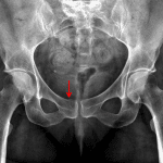 Red arrow: minimally displaced right pubic body fracture with slight superior cortical step-off.