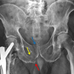 Red arrow: pubic tubercle avulsion fracture. Yellow arrow: inferior pubic ramus fracture (superior ramus fracture is not well seen on this view). Blue arrow: pubic body fracture.