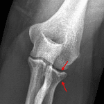 Red arrows: nondisplaced radial head fracture with minimal articular surface impaction.