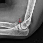 Red arrow: minimally displaced chip fracture of the coronoid process.
