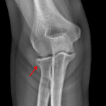 Red arrow: nondisplaced radial head fracture.