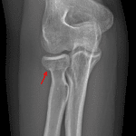 Red arrow: nondisplaced radial head/neck fracture.