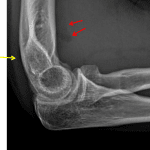Elbow joint effusion with uplifting of the anterior fat pad (red arrows) and more subtle uplifting of the posterior fat pad (yellow arrow).