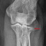 Red arrow: band of sclerosis just beneath the articular surface of the lateral radial head indicating the site of impacted fracture.