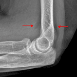Red arrows: uplifting of the anterior and posterior fat pads indicating an elbow joint effusion.