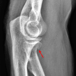Red arrow: mildly displaced radial neck fracture.
