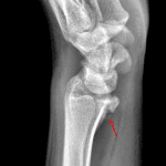 Reverse Barton fracture: minimally displaced oblique fracture through the volar aspect of the distal radial articular surface (red arrow).