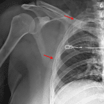 Red arrows: mildly displaced right lateral first and fourth rib fractures.