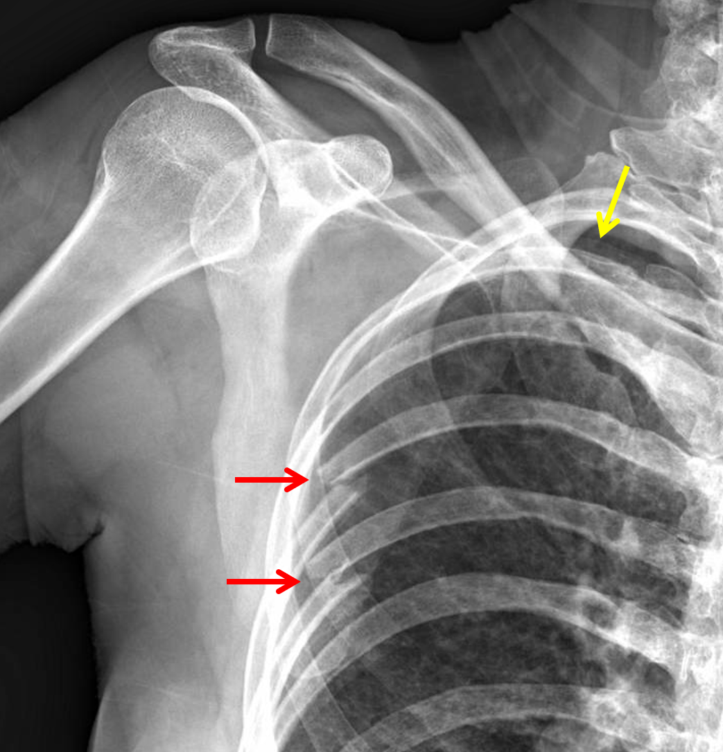 Rib Fracture With Pneumothorax