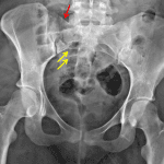 Right sacral fracture with a linear lucency in the sacral ala (red arrow) and offset of multiple arcuate lines on the right (yellow arrows).
