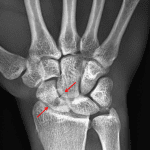 Red arrows: nondisplaced scaphoid waist fracture.