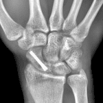 Postoperative radiograph in this patient.