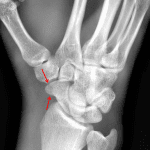 Red arrow: nondisplaced fracture of the distal tubercle of the scaphoid.