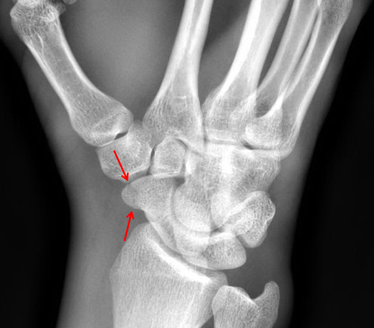 scaphoid bone fracture