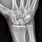Red arrows: nondisplaced scaphoid waist fracture.