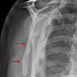 Red arrows: nondisplaced scapular body fracture with cortical irregularity in at least two places on this Y-view.