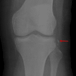 Red arrow: Segond fracture.