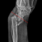 Smith fracture with volar displacement and volar angulation of the distal radial articular surface (red dotted line).