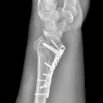 Postoperative radiograph in this patient.