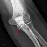 Red arrow: nondisplaced sublime tubercle fracture.