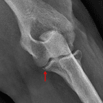 Red arrow: nondisplaced sublime tubercle fracture.