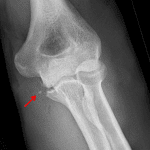 Red arrow: multiple tiny fracture fragments originating from the sublime tubercle and likely also from the medial aspect of the trochlea.