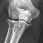 Red arrow: age-indeterminate sublime tubercle fracture.