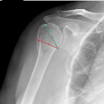 Surgical neck fracture plane (red dotted line). Green dotted line: anatomic neck.