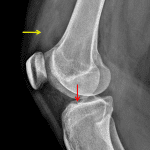 Red arrow: minimal anterior cortical step-off. Yellow arrow: joint effusion.