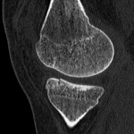 Minimally displaced tibial plateau fracture confirmed on the subsequent CT.