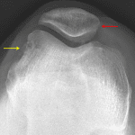 Kissing contusions: cortical irregularity along the medial margin of the patella (red arrow) and along the lateral margin of the lateral femoral condyle (yellow arrow).