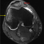 Subsequent MRI shows contusions in the medial patella (red arrow) and lateral femoral condyle (yellow arrow) as well as a patellar avulsion fracture at the MPFL attachment.