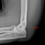 Red arrow: tiny triceps avulsion fracture with surrounding soft tissue swelling.