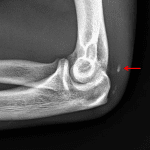Red arrow: distracted triceps avulsion fracture.