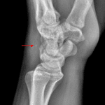 Red arrow: likely triquetral avulsion fracture.