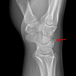 Ossific fragment along the dorsal margin of the proximal carpal row consistent with a triquetral fracture (red arrow).