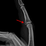 Red arrow: minimally displaced volar plate avulsion fracture.