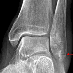 Red arrow: nondisplaced Weber type A fracture.