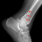 Red arrows: Weber B distal fibular fracture, which is actually best seen on the lateral view in this patient.