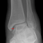 Medial clear space widening. The medial clear space (red line) should not be wider than the other aspects of the ankle mortise (blue and green lines).