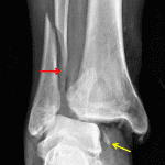 Weber type C fibular fracture (red arrow). Medial malleolar avulsion fracture remains associated with the talus (yellow arrow).