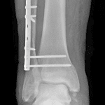 Postoperative radiograph in this patient showing fixation of the fibula and two syndesmotic screws.