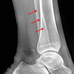 Red arrows: nondisplaced oblique distal fibular diaphyseal fracture.