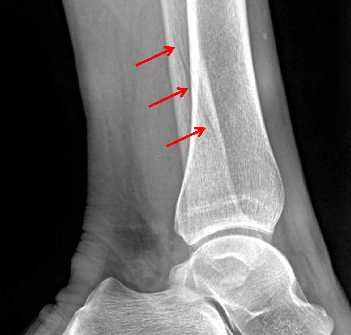 nondisplaced fracture