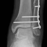 Postoperative radiograph in this patient.