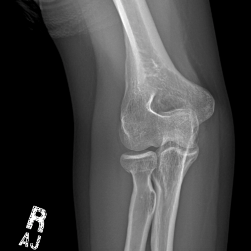 CaseStacks.com — Case #10 — Radial head/neck fracture