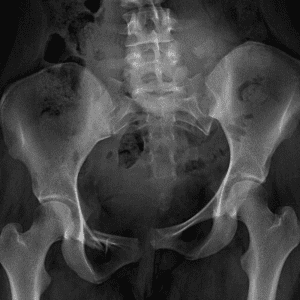 Vertical shear pelvic ring injury