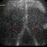 Unexpected area of activity (blue arrow). Common iliac artery aneurysms (red arrows). Activity in the liver (yellow arrow).