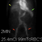 Normal activity in the liver (yellow arrow), spleen (green arrow), and blood pool (red arrows). No abnormal accumulation of radiotracer on early images.
